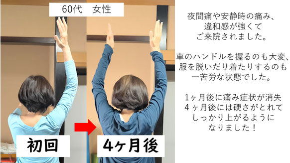五十肩の施術例。初回から4か月後にかけて肩の可動域が改善し、腕を真上まで上げられるようになり、夜間痛も無くなった症例