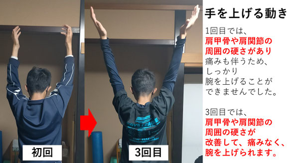 右投げ高校生ピッチャーの野球肩施術前後の手を上げる動きの比較