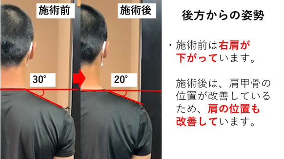 右投げ高校生ピッチャーの野球肩後方からの姿勢施術前後比較　