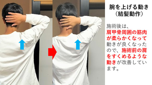 右投げ中学生キャッチャーの野球肩施術前後の腕を上げる動きの比較