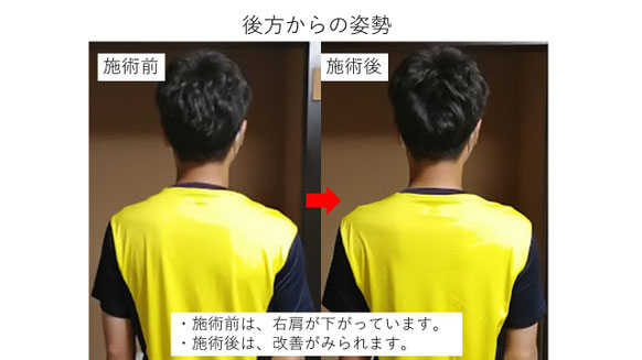 右投げ社会人キャッチャーの野球肩後方からの姿勢施術前後比較　