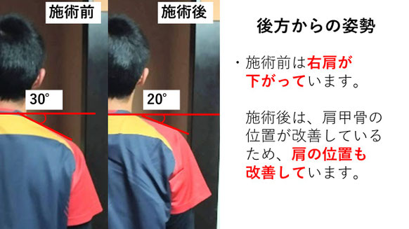右投げ高校生ファーストの野球肩施術前後の後方姿勢比較