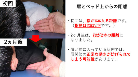 右投げ高校生キャッチャーの野球肩施術前後の肩の位置の比較
