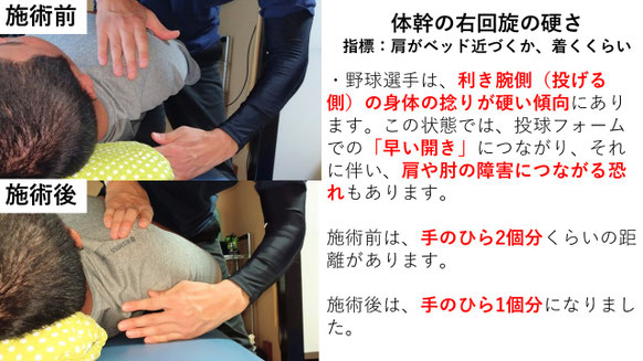 右投げ高校生ピッチャーの野球肩施術前後の体幹の右回旋の比較