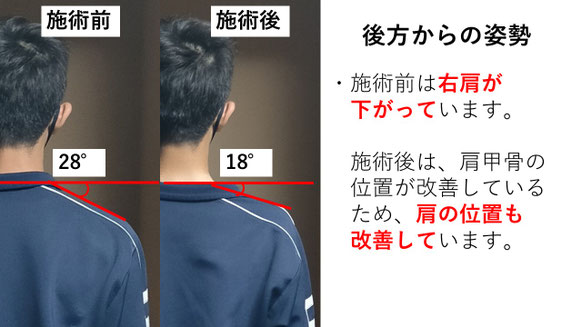 右投げ高校生ピッチャーの野球肩後方からの姿勢施術前後比較　