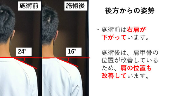 右投げ高校生外野手の野球肩施術前後の後方姿勢比較