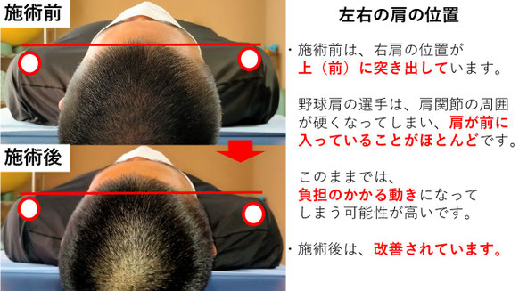 右投げ高校生ピッチャーの野球肩施術前後左右の肩の位置の比較