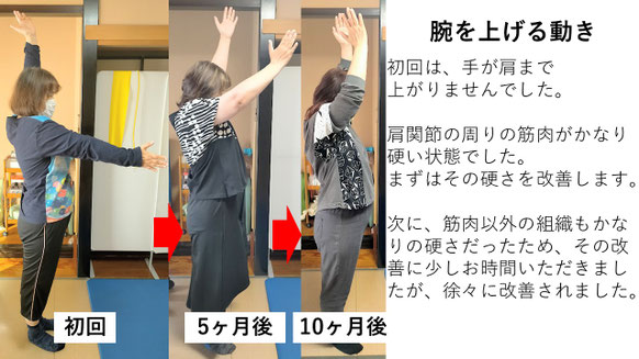 五十肩の施術例。初回から10か月後にかけて肩の可動域が改善し、腕を上げられるようになった症例