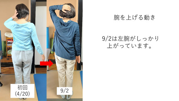 五十肩の施術例。初回から4か月後にかけて肩の可動域が改善し、手を頭の後ろまで上げられるようになり、夜間痛も無くなった症例