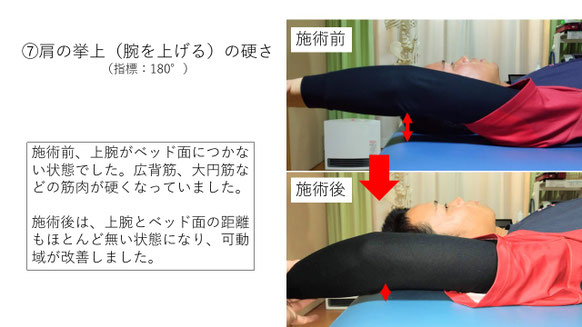右投げ高校生ファーストの野球肩施術前後の手を上げる動きの比較