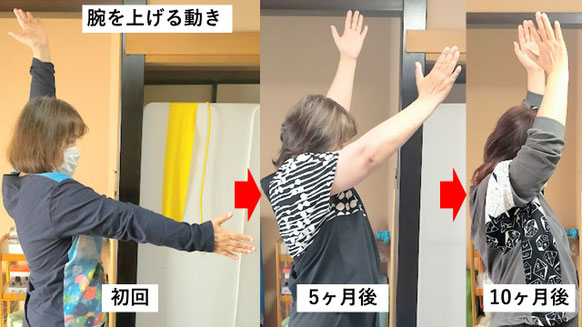 五十肩の施術例。初回から10か月後にかけて肩の可動域が改善し、腕を上げられるようになった症例