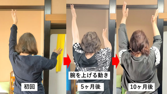 五十肩の施術例。初回から10か月後にかけて肩の可動域が改善し、腕を上げられるようになった症例