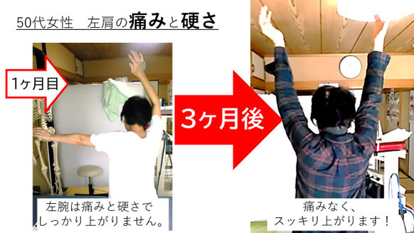 五十肩の施術例。初回から3か月後にかけて肩の可動域が改善し、腕を真上まで上げられるようになった症例
