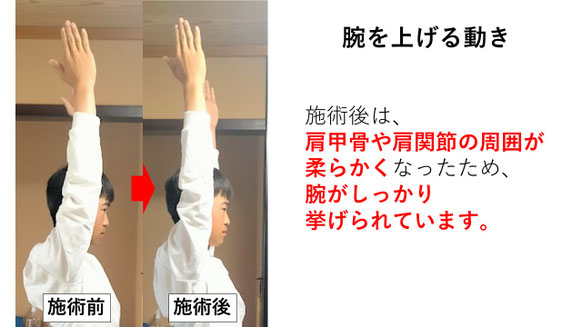 右投げ中学生キャッチャーの野球肩施術前後の腕を上げる動きの比較