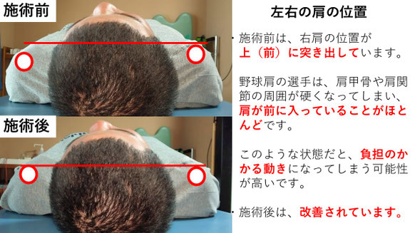 右投げ高校生ピッチャーの野球肩施術前後左右の肩の位置の比較