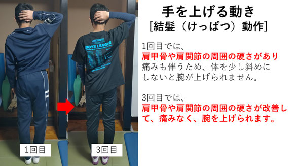右投げ高校生ピッチャーの野球肩施術前後の手を上げる動きの比較