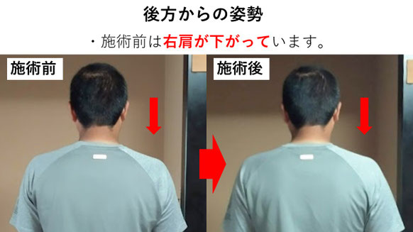 右投げ高校生ピッチャーの野球肩後方からの姿勢施術前後比較　