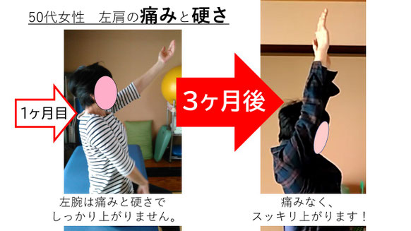 五十肩の施術例。初回から3か月後にかけて肩の可動域が改善し、腕を真上まで上げられるようになった症例
