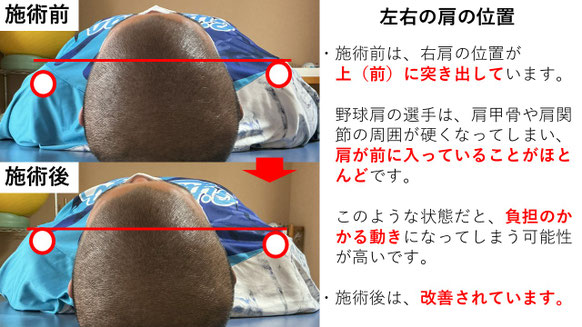 右投げ高校生ピッチャーの野球肩施術前後左右の肩の位置の比較