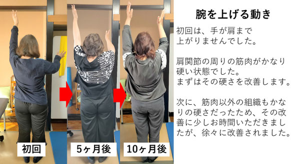五十肩の施術例。初回から10か月後にかけて肩の可動域が改善し、腕を上げられるようになった症例