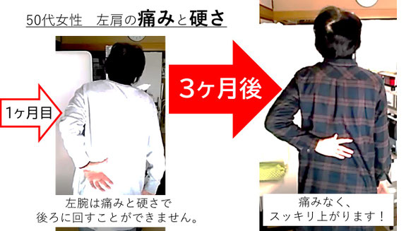 五十肩の施術例。初回から3か月後にかけて肩の可動域が改善し、腕を真上まで上げられるようになった症例