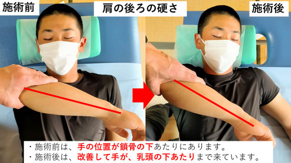 右投げ高校生ピッチャーの野球肩施術前後の肩の後ろの硬さ比較