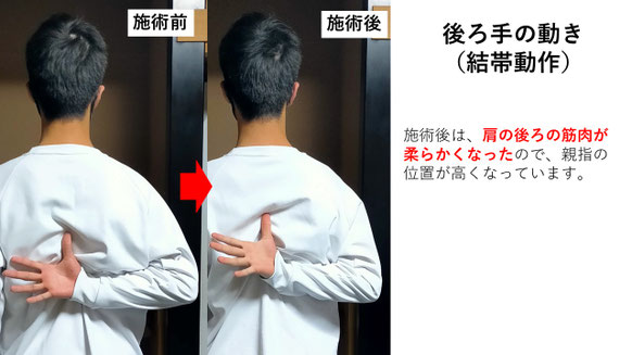 右投げ高校生外野手の野球肩施術前後の後ろ手の動きの比較