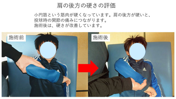 右投げ小学生ピッチャーの野球肩施術前後の肩の後ろの硬さ比較