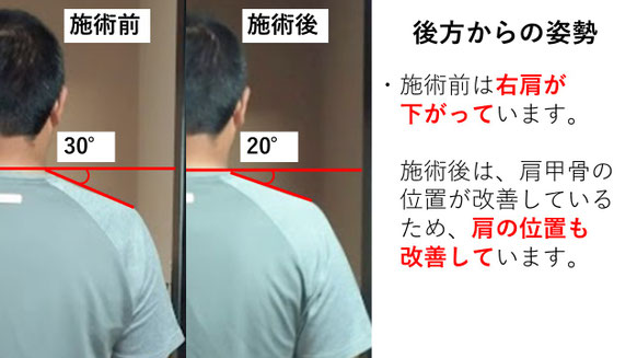 右投げ高校生ピッチャーの野球肩後方からの姿勢施術前後比較　