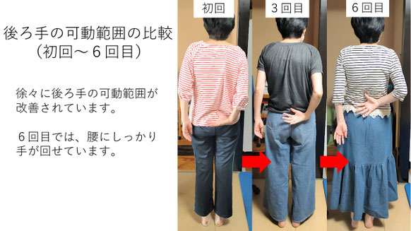 五十肩の施術例。初回から6回目にかけて肩の可動域が改善し、後ろに手が回せるようになった症例。