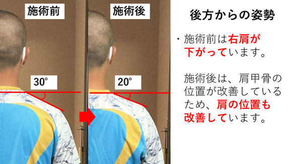 右投げ高校生ピッチャーの野球肩後方からの姿勢施術前後比較