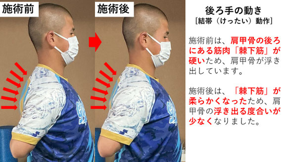 右投げ高校生ピッチャーの野球肩施術前後の後ろ手の動きの比較