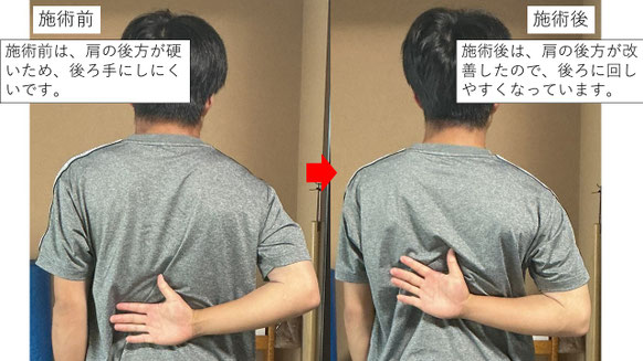 右投げ高校生キャッチャーの野球肩施術前後の後ろ手の動きの比較