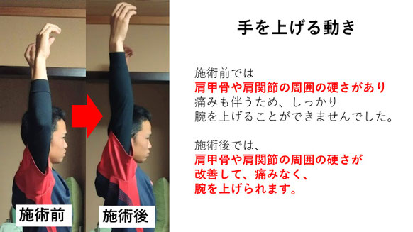 右投げ高校生ファーストの野球肩施術前後の手を上げる動きの比較