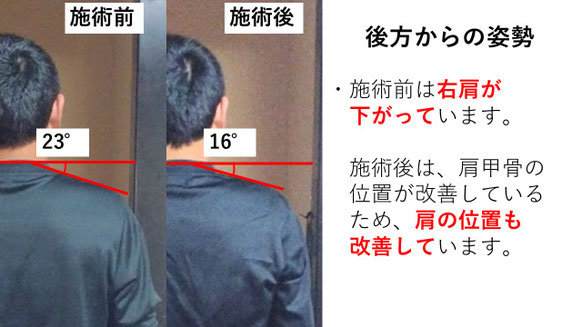 右投げ高校生キャッチャーの野球肩後方からの姿勢施術前後比較　
