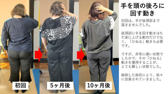 五十肩の施術例。初回から10か月後にかけて肩の可動域が改善し、手を頭の後ろまで上げられるようになった症例