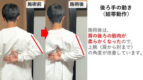 右投げ中学生キャッチャーの野球肩施術前後の後ろ手の動きの比較