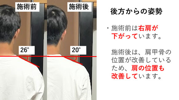 右投げ中学生キャッチャーの野球肩施術前後の姿勢施術前後比較　