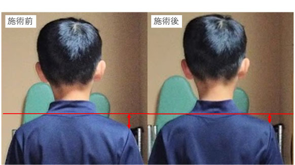 右投げ小学生ピッチャーの野球肩施術前後の姿勢比較