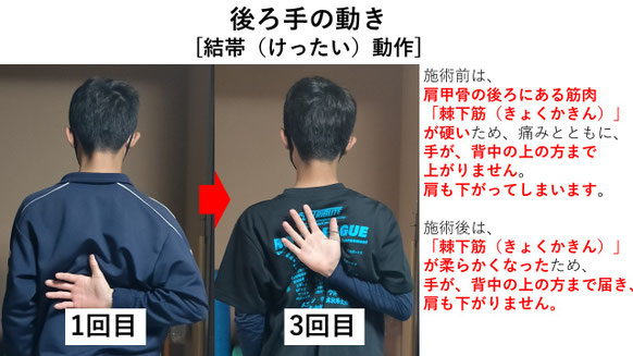 右投げ高校生ピッチャーの野球肩施術前後の後ろでの動きの比較