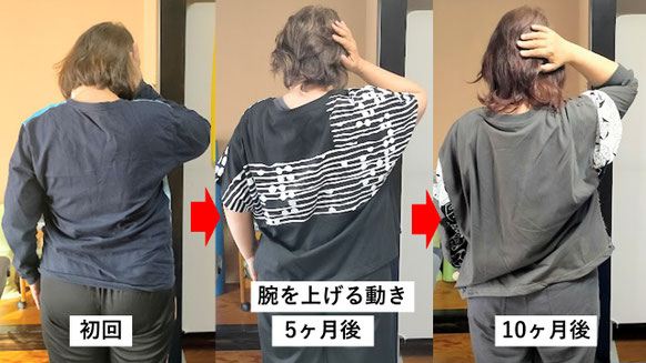 五十肩の施術例。初回から10か月後にかけて肩の可動域が改善し、手を頭の後ろまで上げられるようになった症例