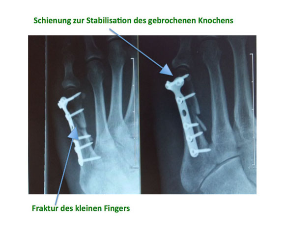 Röntgen Finger Schiene