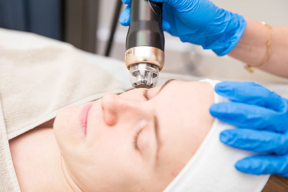 RF Microneedling bei narben