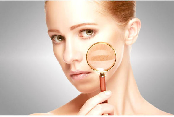 acne marks - a guide how to prevent and heal them