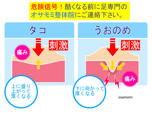 オサモミ整体院 タコ・魚の目