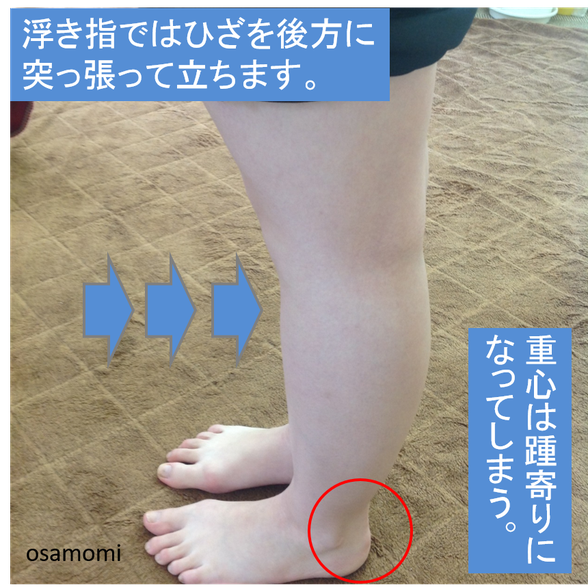 オサモミ整体院 浮き指
