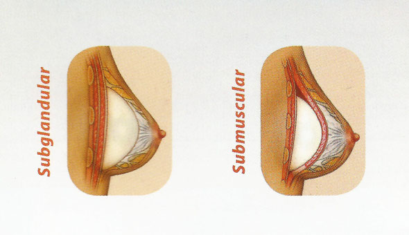 Implantes de Senos