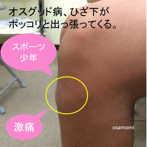 オサモミ整体院 オスグッド病 ひざ痛 浮き指