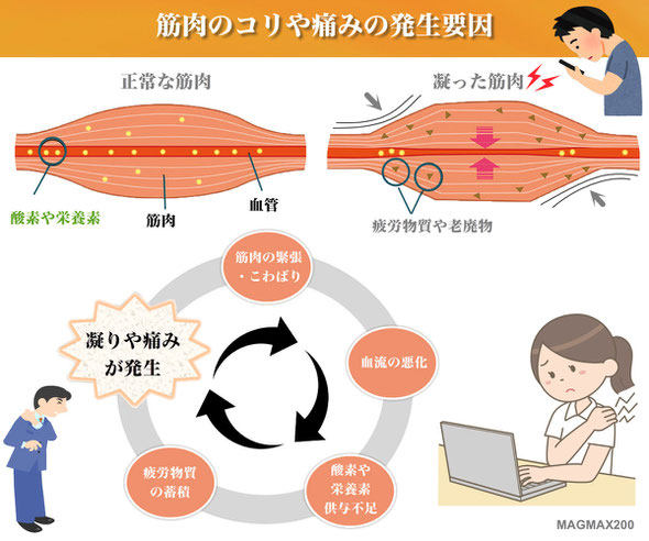 MAGMAX200｜筋肉の凝りや痛みの発生要因について