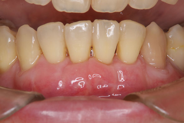歯と歯の間と表側の歯茎の再生治療ケース　